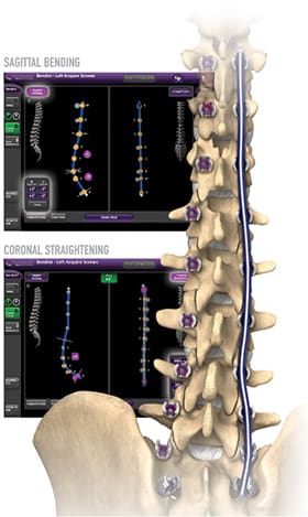 Spinal rod-bending application display with spinal column